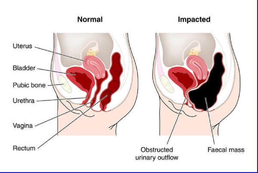 How Does the Colon Cleansing Machine Work